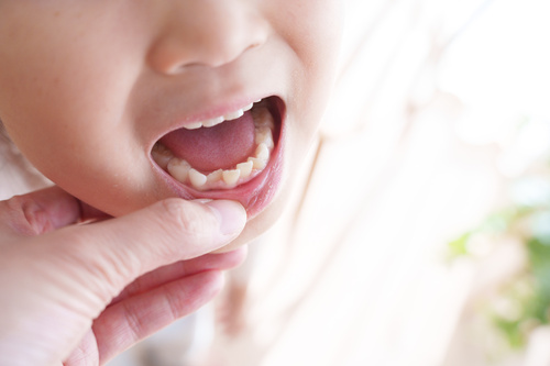 子どものむし歯は進行が早い